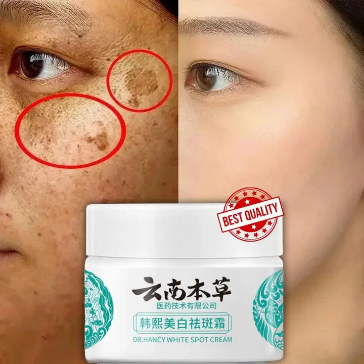 FACIAL CREAM FOR MELASMA