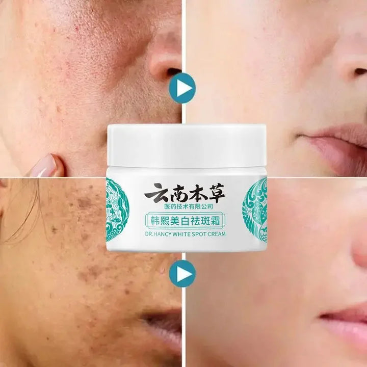 FACIAL CREAM FOR MELASMA