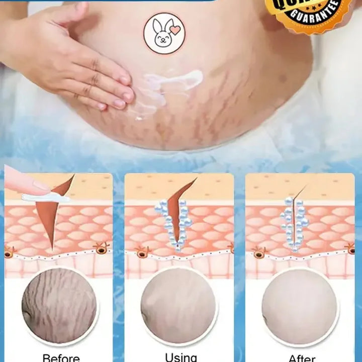 CREAM FOR STRETCH MARKS ON THE BELLY