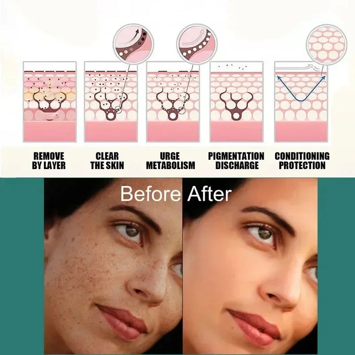 FACIAL CREAM FOR MELASMA