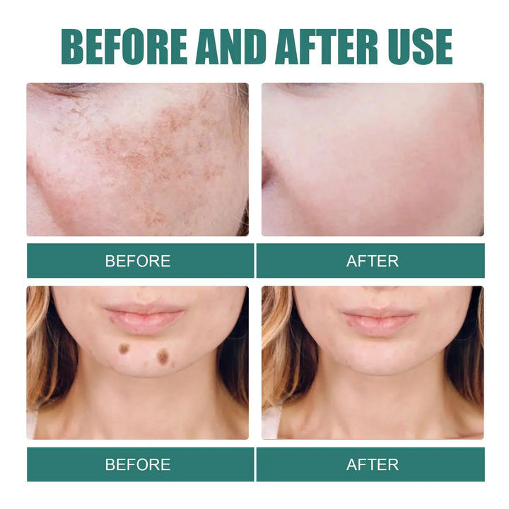 FACIAL CREAM FOR MELASMA